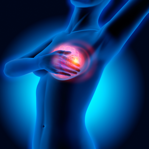 Breast-cancer-rehab-GTS-Physical-Therapy-Arkansas