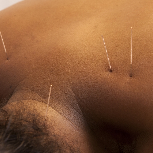 Dry-needling-GTS-Physical-Therapy-Arkansas