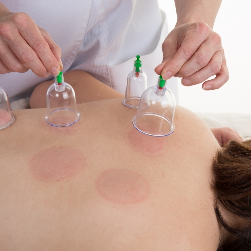 cupping-GTS-Physical-Therapy-Arkansas