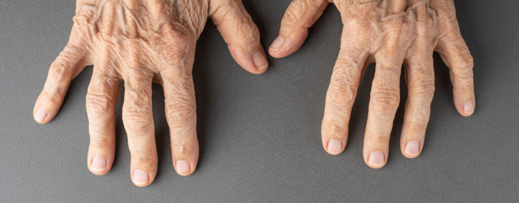 Managing Arthritis Hand Pain with Occupational Therapy
